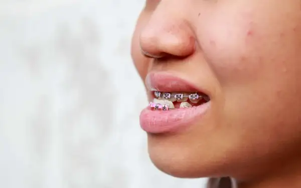 Primo piano di un sorriso con apparecchio ortodontico, inclusi brackets rosa, per correggere un morso inverso.