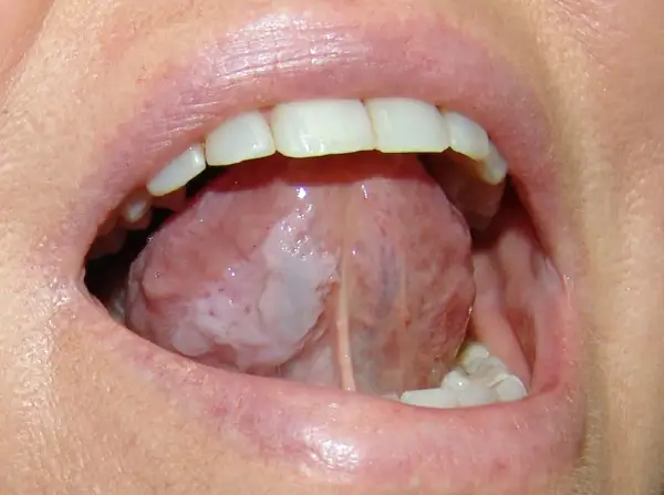Lingua con aree bianche indicative di leucoplachia, potenziale segno precoce di tumore alla lingua.