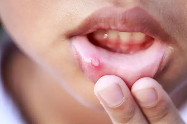 Una piccola vescicola infiammata sulla mucosa orale, vicino alle labbra, evidenziata da un dito.
