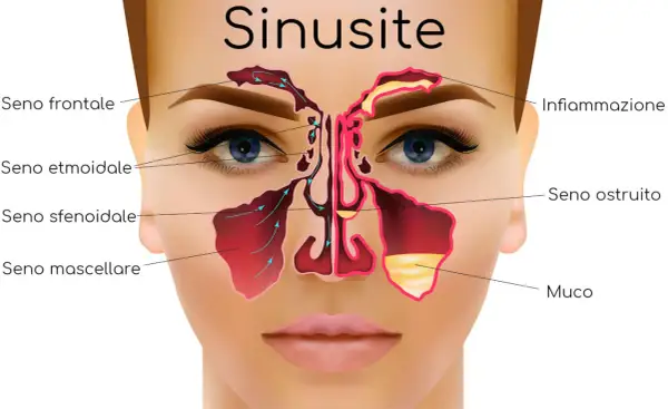 Illustrazione anatomica della sinusite, con enfasi sulla sinusopatia mascellare, mostrando infiammazione e accumulo di muco nei seni paranasali.