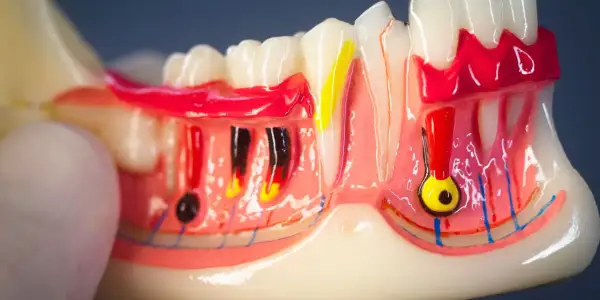 Modello anatomico di denti e gengive, evidenzia il colletto dentale e le strutture sottostanti come nervi e vasi sanguigni.