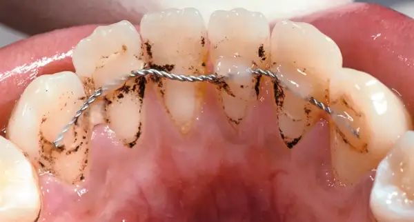 Denti con placca e filo metallico per contenzione denti.
