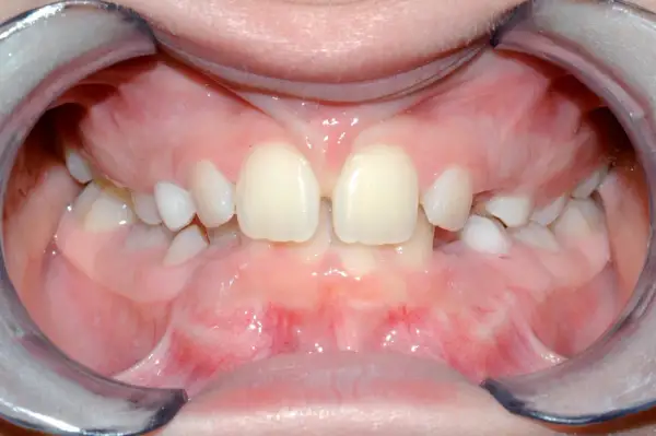 Bocca aperta con denti da latte e il frenulo labiale superiore visibile tra gli incisivi centrali.