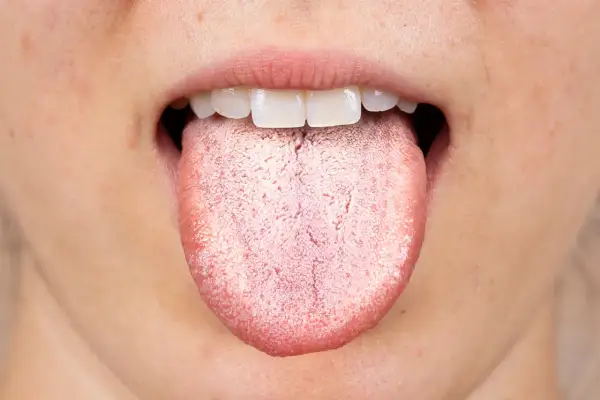 Bocca aperta con lingua che mostra una patina biancastra, quasi una lingua verde per la sua opacità.