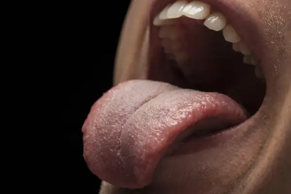 Lingua con patina biancastra, possibile sintomo di candidosi orale in contesto HIV.