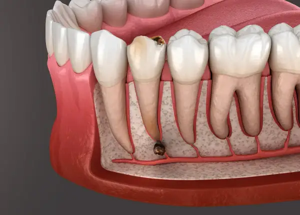 Dente cariato con radice infetta, pronto per l'estrazione. La durata estrazione dente dipende dalla complessità.