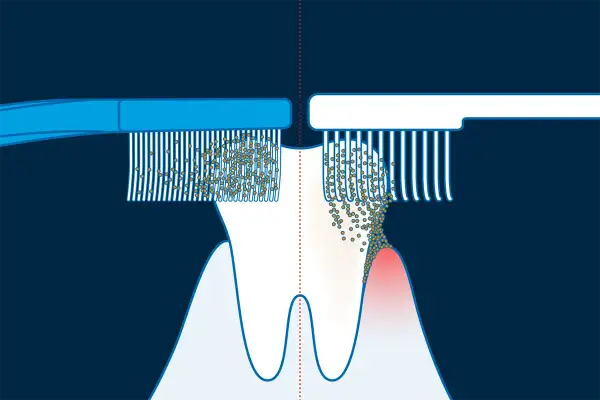 Illustrazione della tecnica di Bass: spazzolino a sinistra pulisce bene, a destra mostra accumulo di placca e gengiva infiammata.