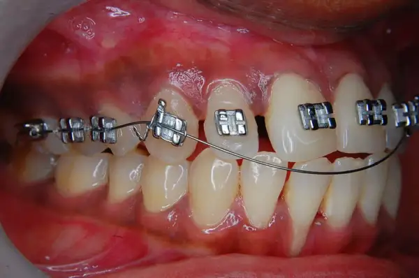 Primo piano di denti con apparecchio fisso. Impossibile togliere l'apparecchio fisso da soli.