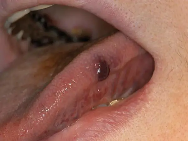 Piccolo fibroma sulla lingua, una piccola escrescenza benigna che necessita di valutazione medica.