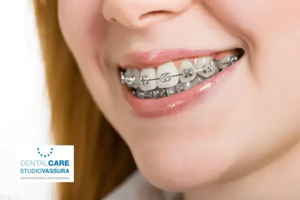 Sorriso con apparecchio ortodontico. L'ortodonzia, il cui significato è allineare i denti, migliora l'estetica e la salute orale.